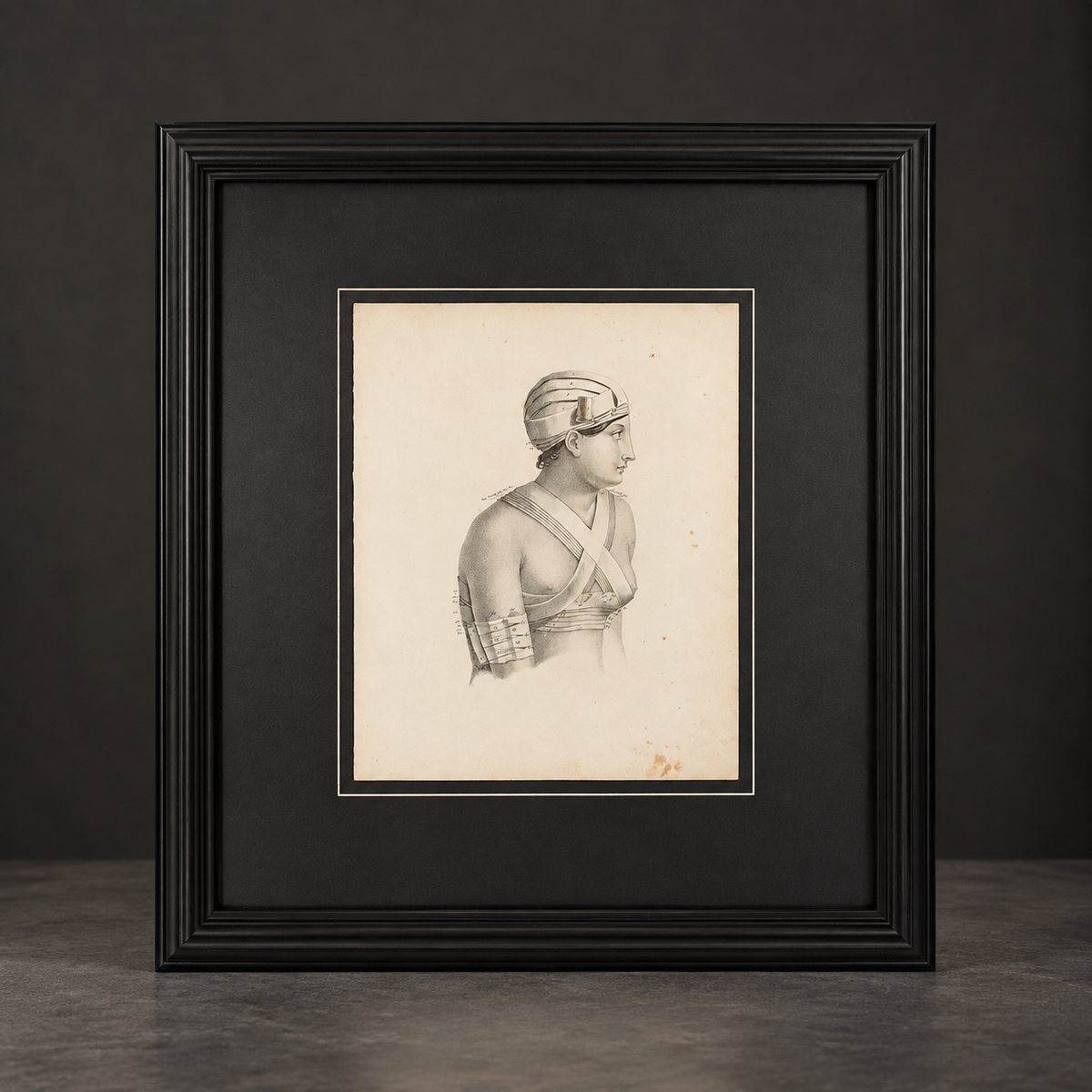 Bandage engraving from "Traité des Bandages" by Gerdy. Paris. 1837. Recent frame. Antique.