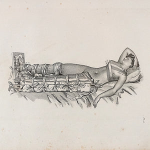 Bandage engraving from "Traité des Bandages" by Gerdy. Paris. 1837. Recent frame. Antique.