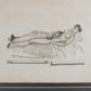 Grabado de vendaje del libro "Traité des Bandajes" de Gerdy, Paris. Año 1837. Marco reciente. Antiguo.