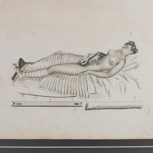 Grabado de vendaje del libro "Traité des Bandajes" de Gerdy, Paris. Año 1837. Marco reciente. Antiguo.
